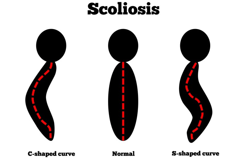 Murrieta, CA scoliosis treatment